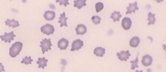 <p>variation in RBC shape</p><p>- reporting is specific to lab</p><p>Conditions Assoc: Severe anemia, Hemolytic states</p>