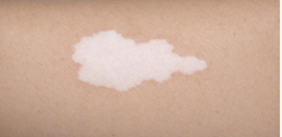<p>Cambio de color plano, no palpable y ≤1 cm.</p>