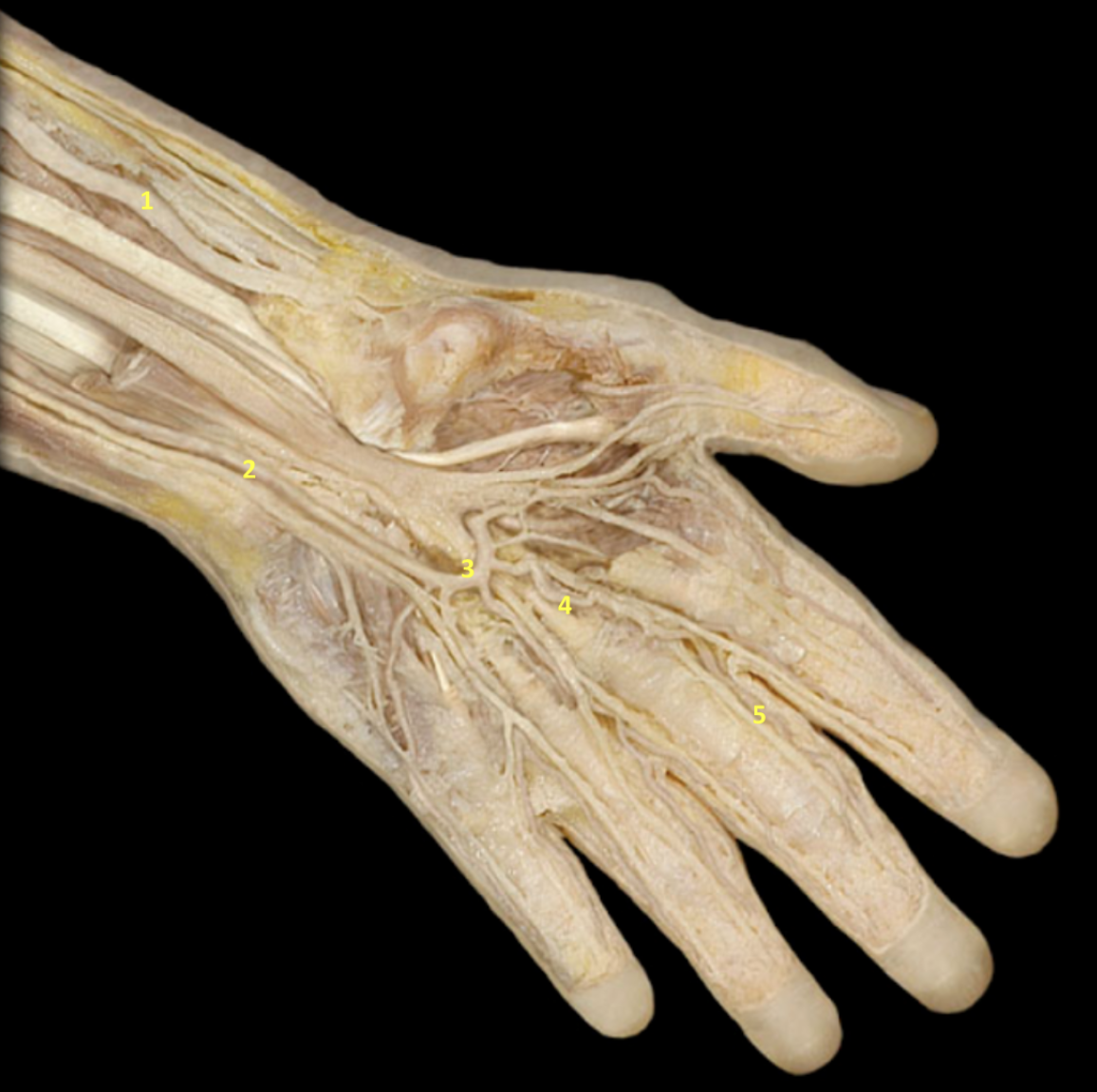 <p>Hand - Deep Dissection</p><p>1. Left radial artery</p><p>2. Left ulnar artery</p><p>3. Left palmar arch</p><p>4. Left metacarpal artery</p><p>5. Left digital artery</p><p></p>