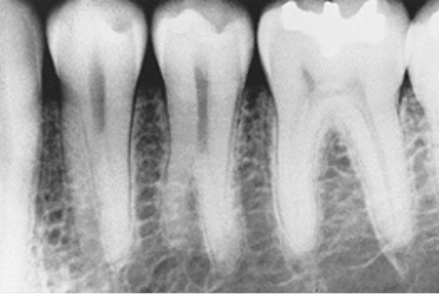 <p><br></p><p>Location: maxillary and mandibular 3rd molars, premolars, and cuspids</p><p>*visible extra roots</p><p><br><span>What is the developmental anomaly seen in this radiographic image?</span></p>