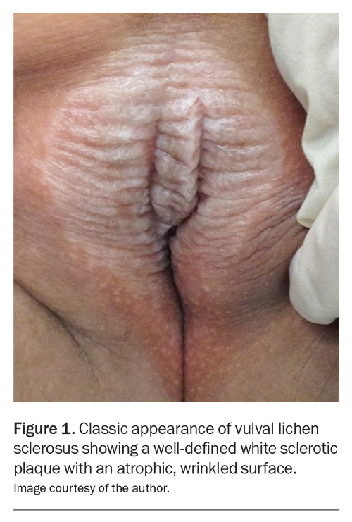 <p>Skin thickening in patients with vulvar dermatitis secondary to repetitive rubbing and scratching</p><p>-Presentation: pruritis, burning, stinging, and rawness. Physical exam shows thickening of vulvar skin and accentuation of normal skin markings, skin appears whitened </p><p>-Dx: clinical </p><p>-Tx: 1st generation antihistamines, topical corticosteroids </p>