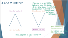 <p>Which pattern will cause more symptoms for an Exo patient?</p>
