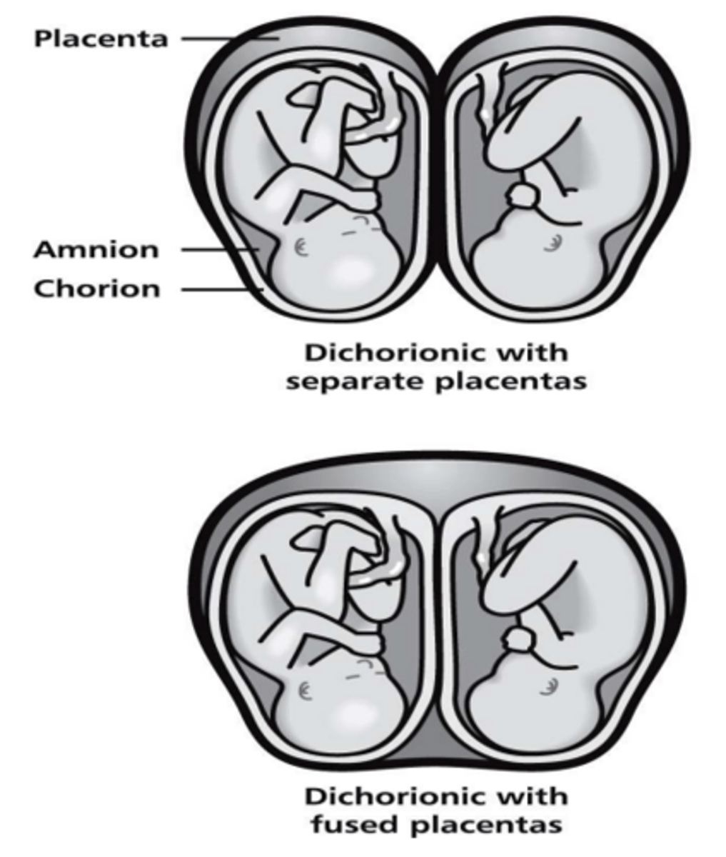 <p>2 placenta or 1 fused placenta/ 2 amnios/2 chorions</p>