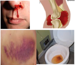 <p>Excessive and spontaneous hemorrhaging into joints, mm, cranium, and mucus membranes due to hereditary clotting deficiency</p><p>- severe cases could turn into hematomas</p><p>- modift MSK exam d/t bleeding risk</p>