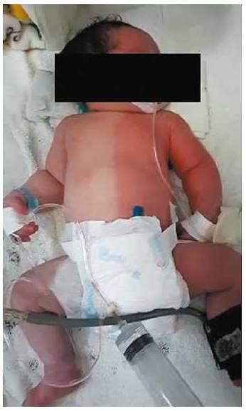 <p>Distinct line of red/pale color down the midline or horizontal found in newborns, one half of body turns red and blanches</p>