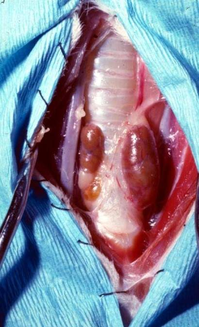 <p>Bilateral/unilateral surgical removal of thyroid gland </p>