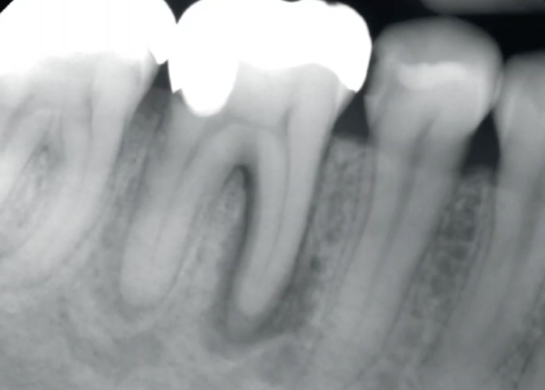 <p>spontaneous Pain, non-vital pulp test, apical radiolucency are most consistent with which diagnosis? </p>