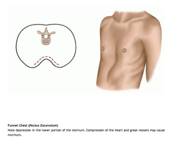 <p>aka funnel chest</p><p>congenital chest wall deformity where the breastbone (sternum) and ribs grow inward, creating a sunken appearance</p>