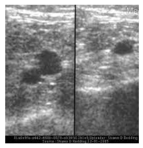 <p>Lumen is anechoic and walls of vein will coapt entirely with gentile transducer pressure</p>