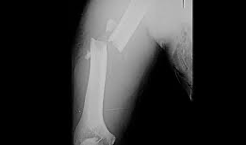 <ul><li><p>May not be obvious to the untrained eye</p></li><li><p>Often there is swelling around the injured areas, pain, and deformity of the limb</p></li><li><p>All or some of these symptoms may be absent and this fracture still present</p></li></ul><p></p>