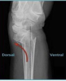 <p>distal radius fracture - colle’s fracture </p>