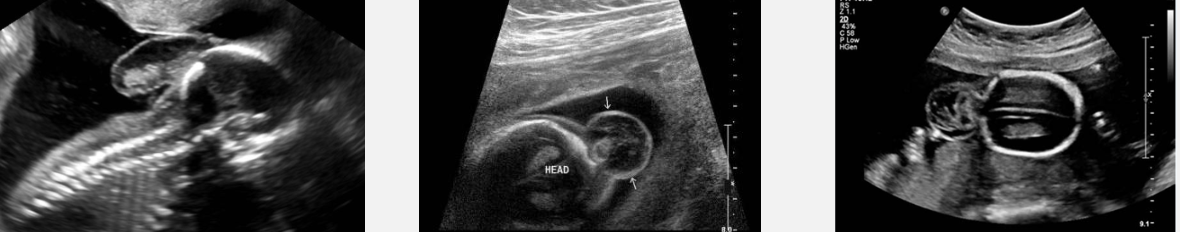 <ul><li><p>Extracranial mass: may be fluid filled or contain solid components</p></li></ul><p>• Cranial defect</p><p>• Ventriculomegaly</p>