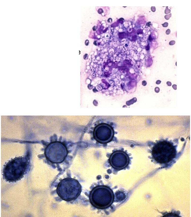 <p>-Small, narrow yeast in tissues (easy to confuse with other pathogens)</p><p>-Septate, hyaline, hyphae with spiny macroconidia</p>