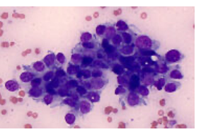 <p>Epithelial tumor cytology</p>