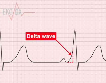 <p>Classic of WPW (Wolff-Parkinson-White Syndrome), extra pathway lets impulses reach the ventricles early. </p><ul><li><p>short PR int (<120ms)</p></li><li><p>slurred upstroke or QRS (delta wave) </p></li><li><p>often wide QRS</p></li></ul><p>but may be asymptomatic, episodes of SVT (AVRT), palpitations, </p><p></p>