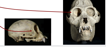 <p>• Forward rotation of the orbits.</p><p>• Narrow interorbital distance.</p><p>• Enlargement of orbital cavity.</p><p>• Complete post-orbital bar/plate</p>