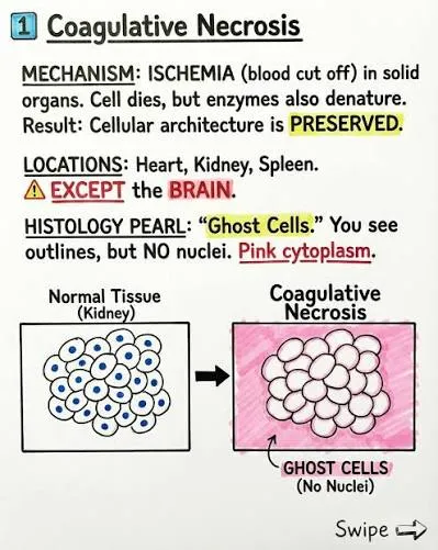 <p>Coagulative necrosis is localised tissue death in which <span><strong>cellular detail is lost, but the overall tissue architecture is preserved.</strong></span></p><p>Think: Coagulative Necrosis= "Ghost tissue."</p><p>a.k.a. You can still recognise the organ, but the individual cells are dead.</p>