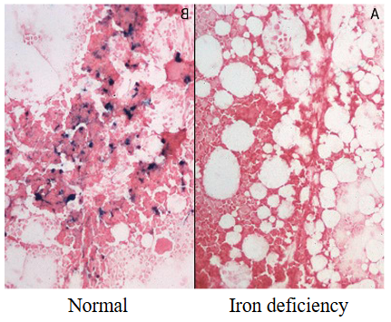 <p>Lab Features of Iron Deficiency Anaemia</p>