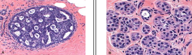 <p>proliferative with atypia breast disorders?</p>