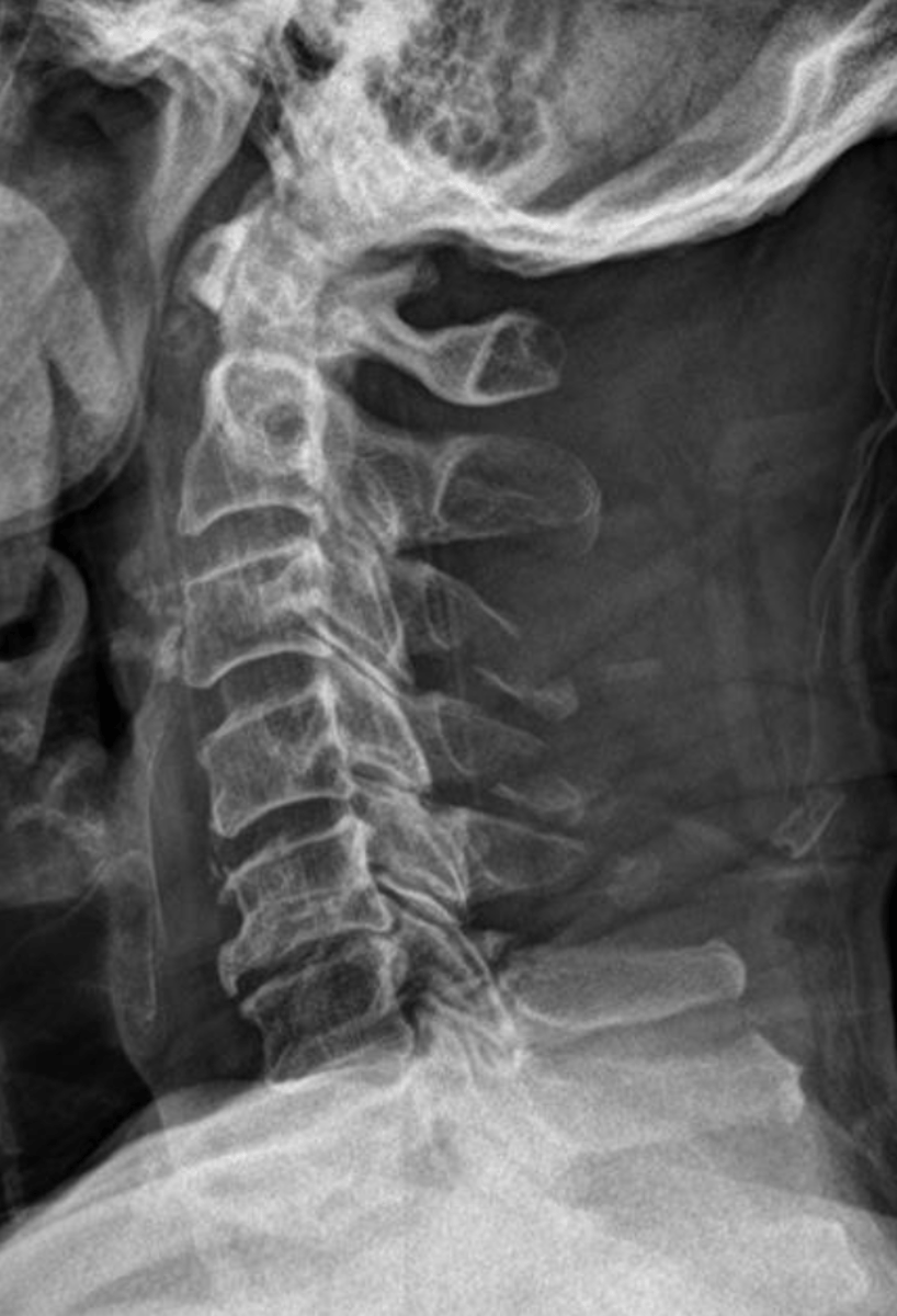 <p>If the mechanism was extension or direct trauma what is the likely diagnosis?</p>
