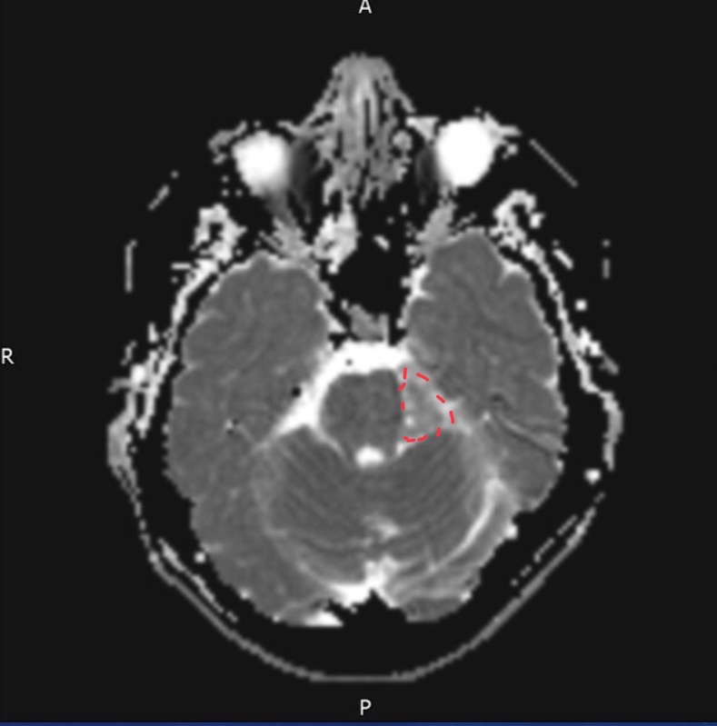 <p>55-year-old woman presents with left facial droop</p>