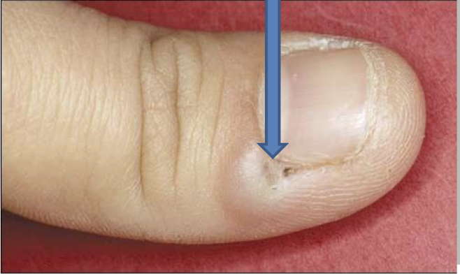 <p>what is this lesion and how is it caused</p>