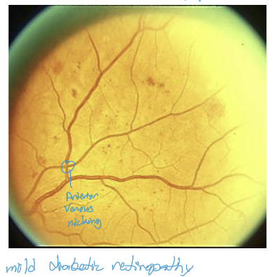 <p>Diabetes mellitus. Microaneurysms are often the first or one of the earliest clinical signs of diabetic retinopathy.</p>