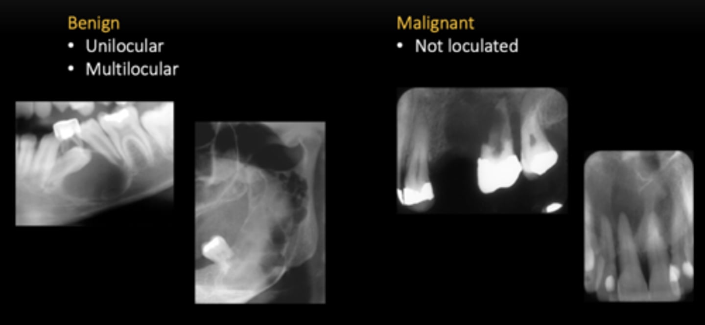 <p>Benign:</p><p>- Unilocular </p><p>- Multilocular </p><p>Malignant:</p><p>- Not loculated </p>