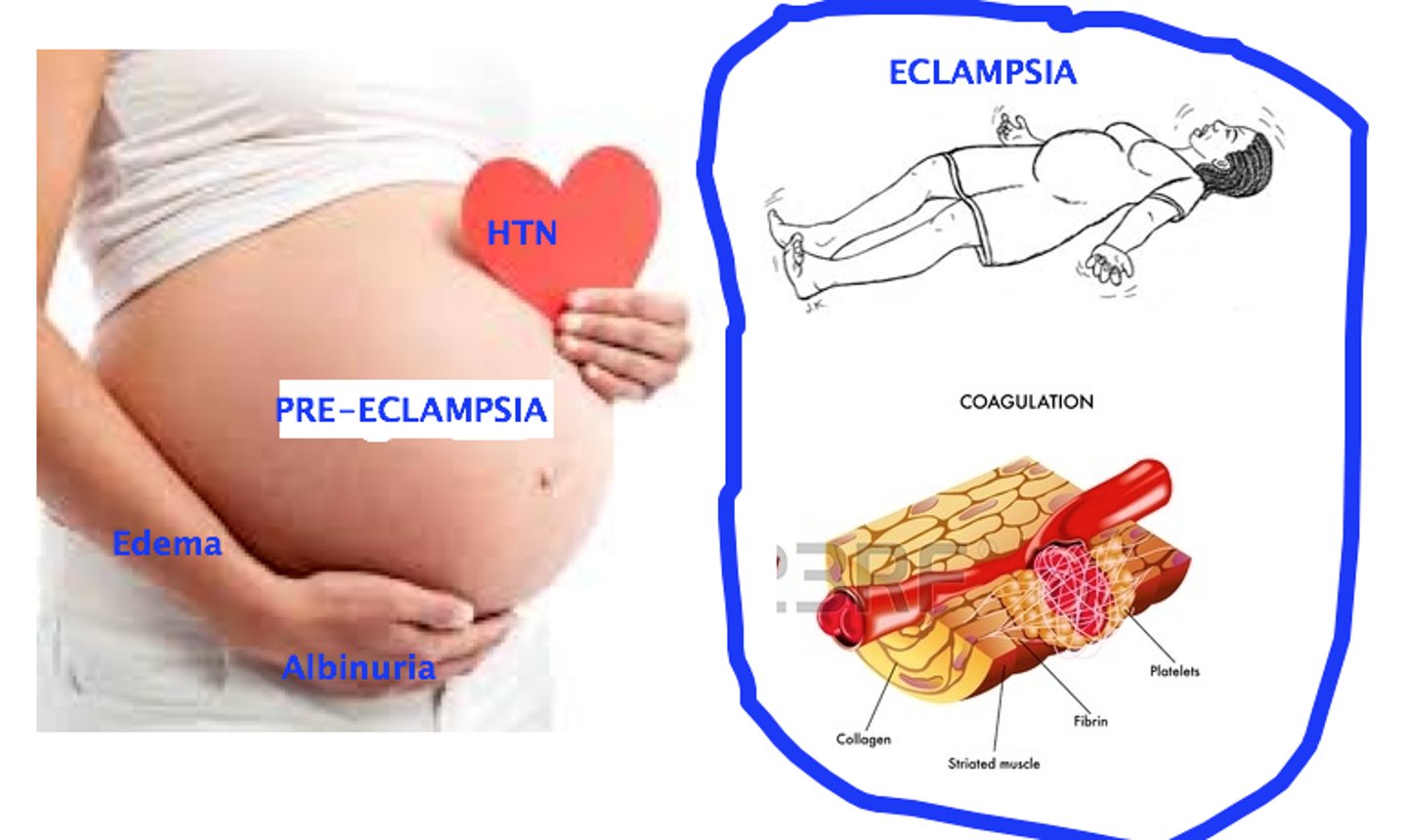 <p>when preeclampsia (HTN + proteinuria/organ damage) progresses to seizures</p><p>-> can cause maternal/fetal death</p>