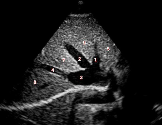 <p>Which of the following structures is labelled #3?</p><p>a. IVC</p><p>b. left hepatic vein</p><p>c. middle hepatic vein</p><p>d. left portal vein </p>