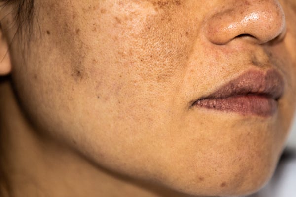 <p><span><em>Melasma / Blemishes</em></span></p>