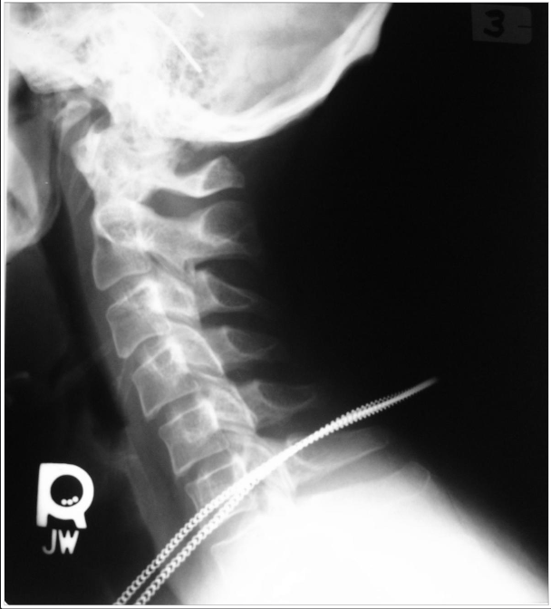 <p>Is this film of diagnostic quality (Lateral Cervical) </p>