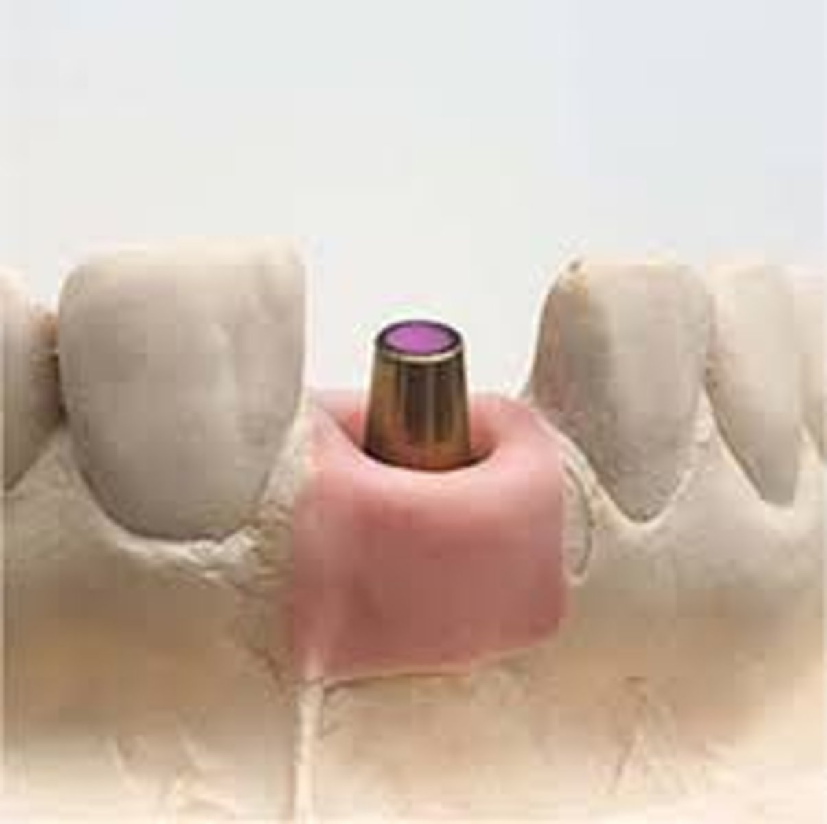 <p>Screwed or Cement Retained?</p>