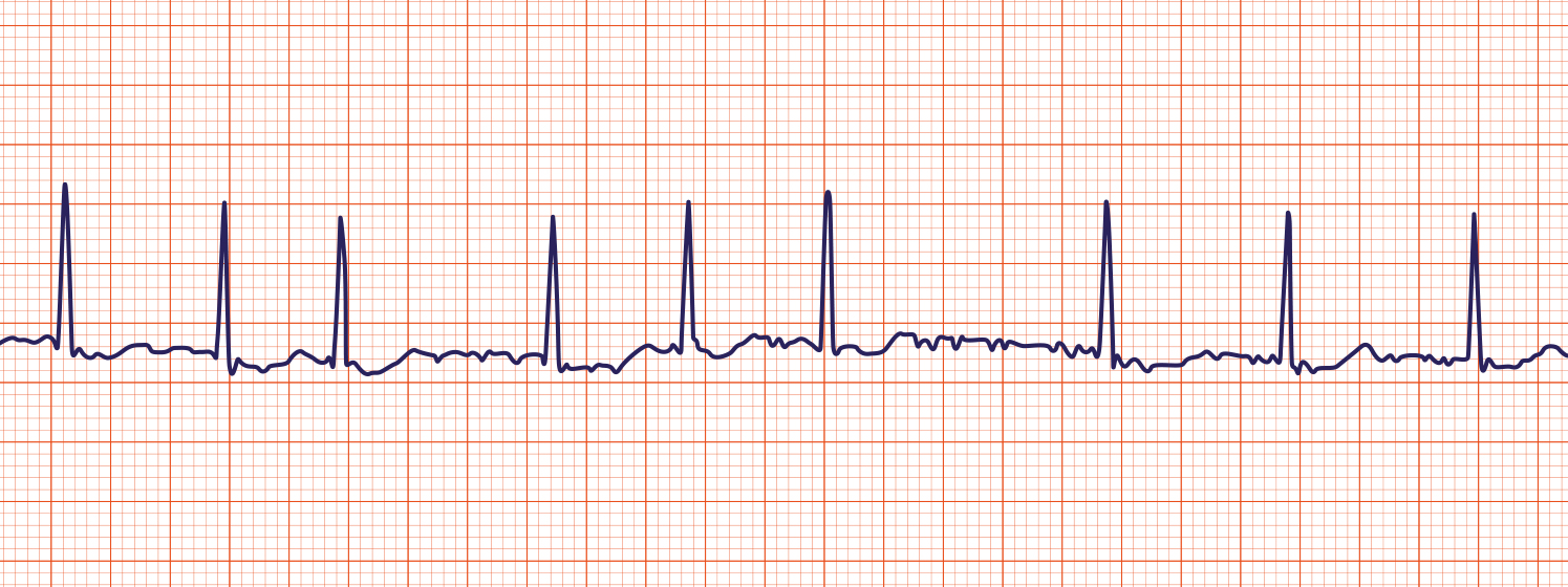 <ul><li><p>Irregularly irregular rhythm</p></li><li><p>No clearly identifiable normal P waves </p></li><li><p>High risk of thrombus / stroke </p></li><li><p></p></li></ul><p></p>