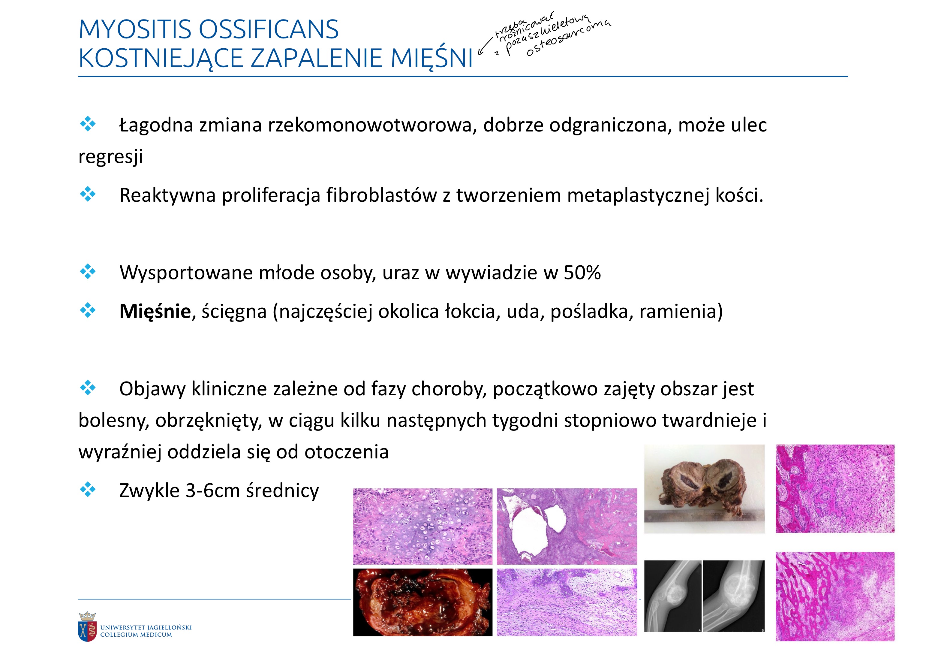 <p>❖ Łagodna zmiana rzekomonowotworowa, dobrze odgraniczona, może ulec regresji</p><p>❖ Reaktywna proliferacja fibroblastów z tworzeniem metaplastycznej kości.</p><p>❖ Wysportowane młode osoby, uraz w wywiadzie w 50%</p><p>❖ Mięśnie, ścięgna (najczęściej okolica łokcia, uda, pośladka, ramienia)</p><p>❖ Objawy kliniczne zależne od fazy choroby, początkowo zajęty obszar jest bolesny, obrzęknięty, w ciągu kilku następnych tygodni stopniowo twardnieje i wyraźniej oddziela się od otoczenia i staje się bezbolesny</p><p>❖ Zwykle 3-6cm średnicy</p><p>❖ Wycięcie jest równoznaczne z wyleczeniem</p><p>❖ Charakterystyczna budowa strefowa – miękki środek (fibroblasty) oraz skostniały obwód</p><p>❖ Istnieje postać dziedziczona AD, zmiany powstają bez wystąpienia urazu</p><p>❖ Diagnostyka różnicowa – extraskeletal osteosarcoma (osoby starsze, komórki nowotworowe, brak strefowości zmiany)</p>