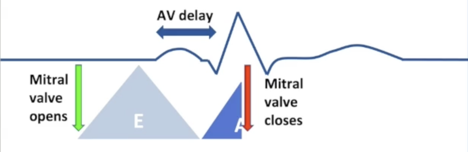 <ul><li><p>AV delay too short:</p><ul><li><p>Ventricular contraction begins during atrial systole</p></li><li><p>A wave is truncated by closing of mitral valve</p></li><li><p>Less time for filling</p></li><li><p>Systolic MR</p></li></ul></li></ul><p></p>