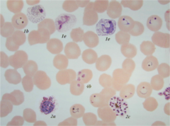 <p>Protist that causes malaria. The plasmodium is purple, and outside of the circular red blood cells.</p>