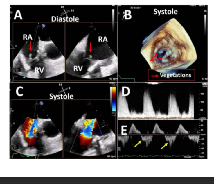 <p>A DVI of >3.3 in the context of increased transvalvular gradient and normal</p><p>PHT help confirm the presence of significant TR</p>