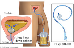 <p>Indwelling, with a balloon tip inflated inside the bladder</p>