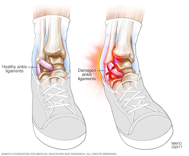 <p><strong>Sprain</strong></p>