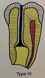 <p>“dens in dente” type III</p>