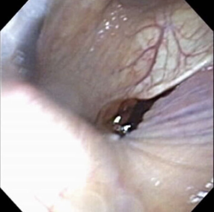 <p>You are examining a 7 year old Thoroughbred gelding for severe bilateral epistaxis. After the epistaxis has decreased, endoscopy of the pharynx reveals blood from the left guttural pouch opening (see image). What is the most appropriate treatment for hemorrhage from guttural pouch mycosis?</p><p>A. Pass endoscope into affected guttural pouch and cauterize involved vasculature</p><p>B. Surgical occlusion of involved arteries (i.e. internal or external carotid artery) under general anesthesia</p><p>C. Lavage guttural pouch with antifungals</p><p>D. Tie off the left common carotid artery</p>