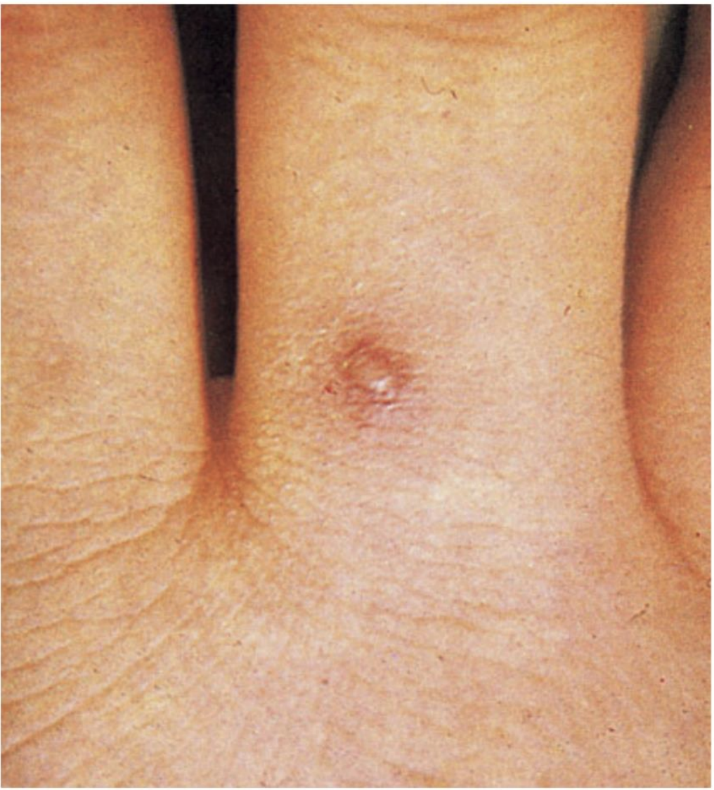 <p>A 24-year-old woman develops <strong>migratory pain in multiple joints</strong>, a swollen knee, and several tender pustules on her extremities shortly after the onset of menstruation. Which medication is most effective?</p>