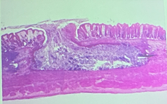 <p>Flask-shaped Ulcer<br>E. histolytica</p>