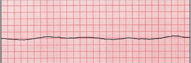 <p>Asystole (flatline)</p>