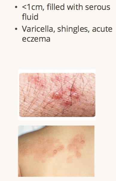 <p>primary lesion fluid filled </p>