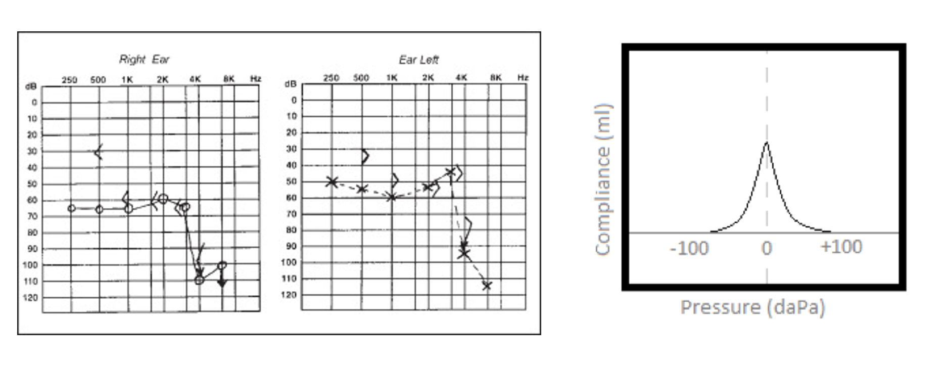 <p>Mixed loss-conductive components</p><p class="p1">Middle ear is normal</p><p class="p1">Present ARTs</p>