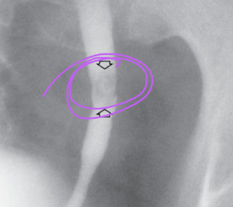 <ul><li><p>Formed in the kidneys</p></li><li><p>Asymptomatic (no pain) until they lodge in the ureter and cause partial obstruction (extreme pain)</p></li></ul><p></p>