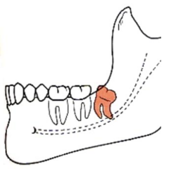 <p>ID the angulation classification of the impacted 3rd molar:</p>