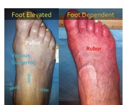 <p>What is the difference between foot elevated and foot dependent PAD? (peripheral arterial disease) </p>